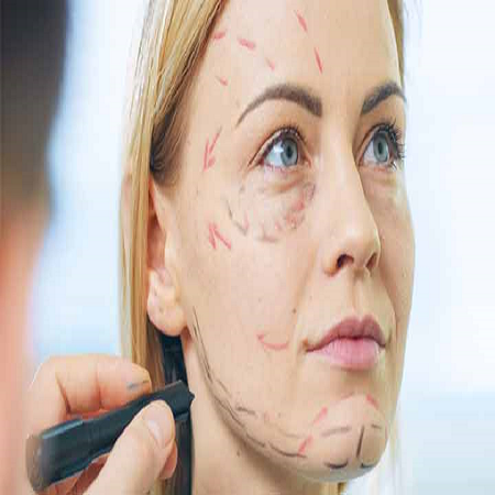 facelift surgeon